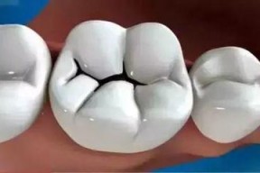 补牙视频,跟随视频学习牙齿修复技巧